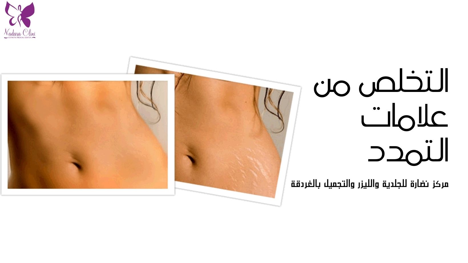 التخلص من علامات التمدد